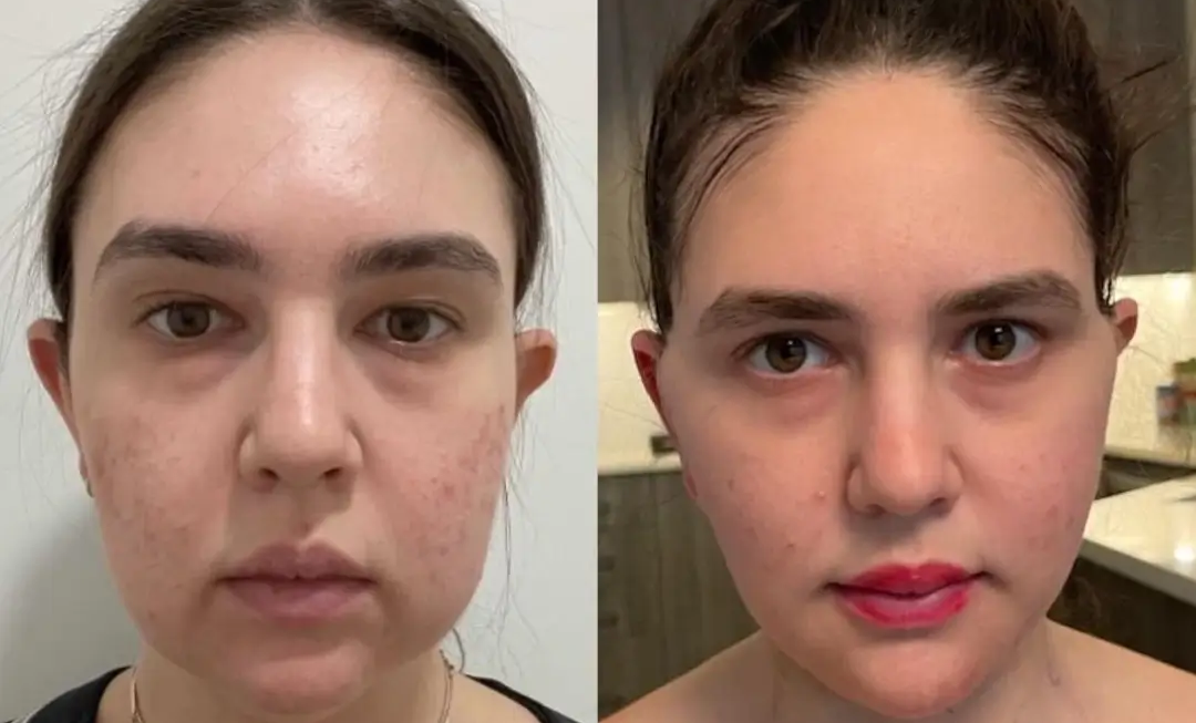 Buccal Fat Removal in Dubai