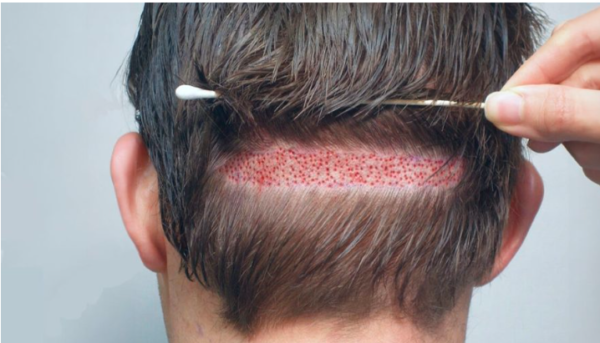 Advanced Hair Transplant Techniques by Dr Burhan Ashraf in Pakistan