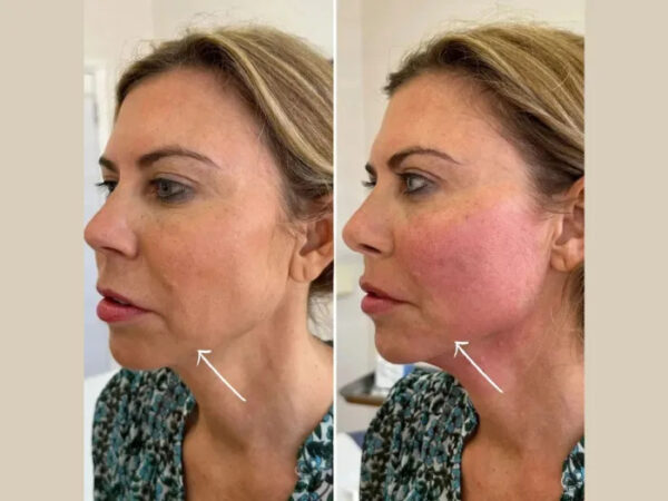 Best Aesthetic Clinic in dubai Discusses Endolift for Neck and Double Chin Tightening