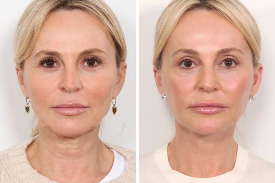 Best Plastic Surgeon in Dubai Offer Elegant Thread Lift Enhancements