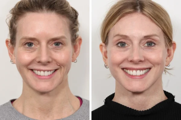 Best Aesthetic Clinic in Dubai on Thread Lift for Facial Rejuvenation