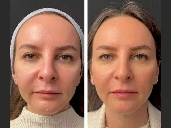 Best Doctors in dubai for Mesotherapy Aftercare and Follow-Up