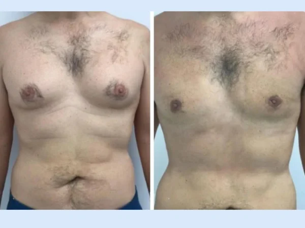 Gynecomastia Surgery in Dubai: How Modern Technology Ensures Natural Results