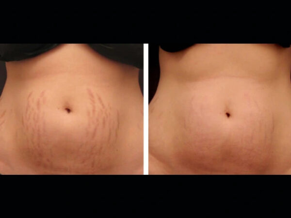 Younger Appearance with Radiofrequency (RF) Microneedling Best Doctors in dubai