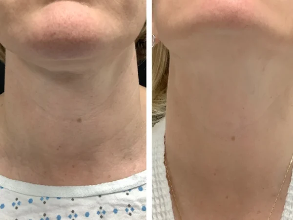 Expert Care from Radiofrequency (RF) Microneedling Best Doctors in dubai