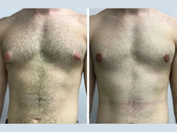 How the Best Gynecomastia Surgeons in Dubai Approach Male Breast Reduction