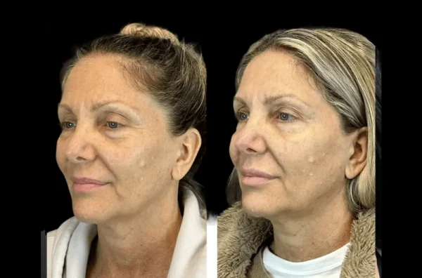 Why Professionals Prefer Botox Treatment in Dubai for Subtle Enhancements