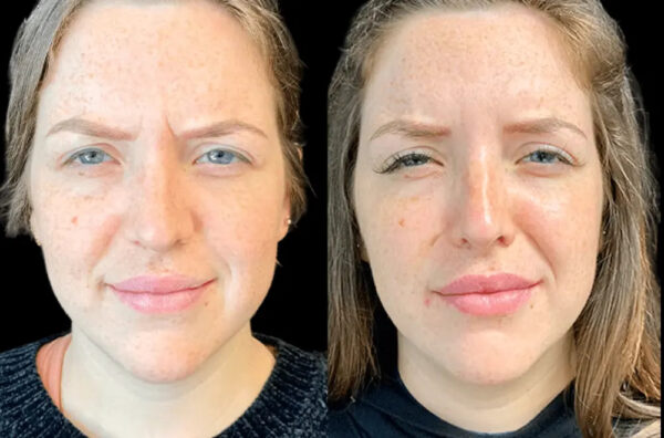 Botox Treatments in Dubai: Choosing the Right Clinic and Practitioner