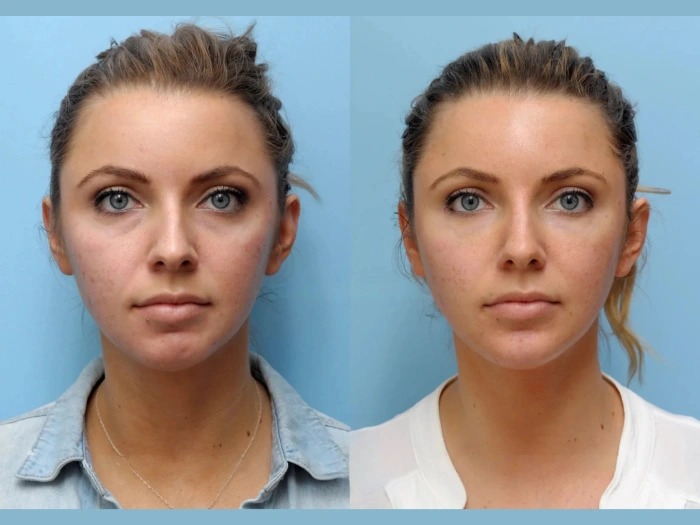 Best Doctors in Dubai Elevate Facial Aesthetics Through Advanced Thread Lift