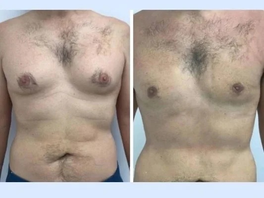 How the Best Gynecomastia Surgeons in Dubai Ensure a Smooth Post-Operative Journey