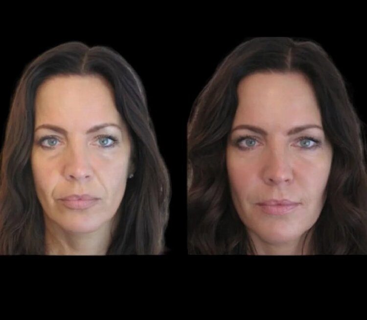 Jawline Fillers in Dubai