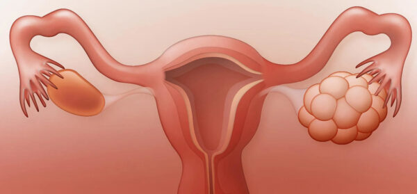 Polycystic Ovary Syndrome (PCOS): Symptoms and Causes