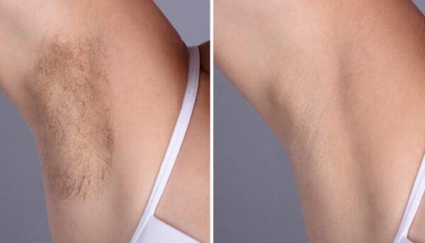 Best Doctors in dubai Guide You on Choosing the Right Clinic for Laser Hair Removal