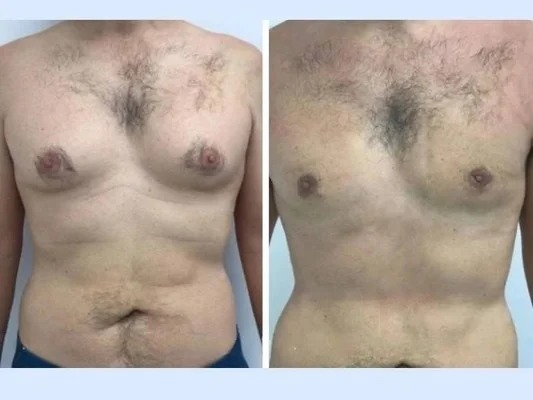 Best Gynecomastia Surgeons in dubai: Before and After Success Stories